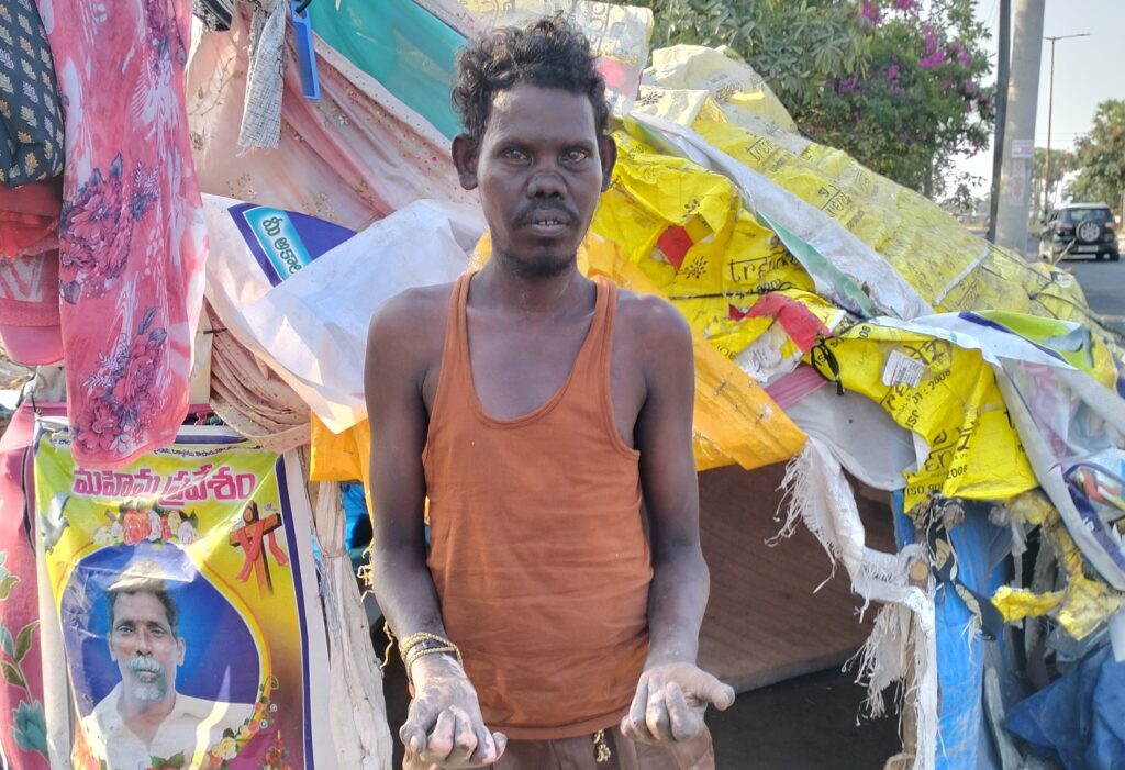 Young Man With Leprosy Rejected By His Relatives But Accepted Into The Family of God